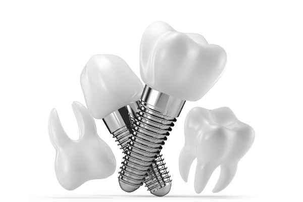 The Advantages Of Choosing An Implant Dentist For Tooth Replacement