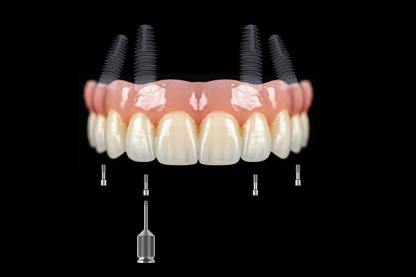 How The Placement Angle Affects All On   Implants